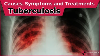 Tuberculosis article header – First Aid Article in Mittagong